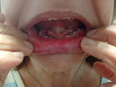 Una vecina de Moaña, víctima del cierre de la clínica dental: «Tuve que armarme de valor, llevo dos semanas sin dormir»